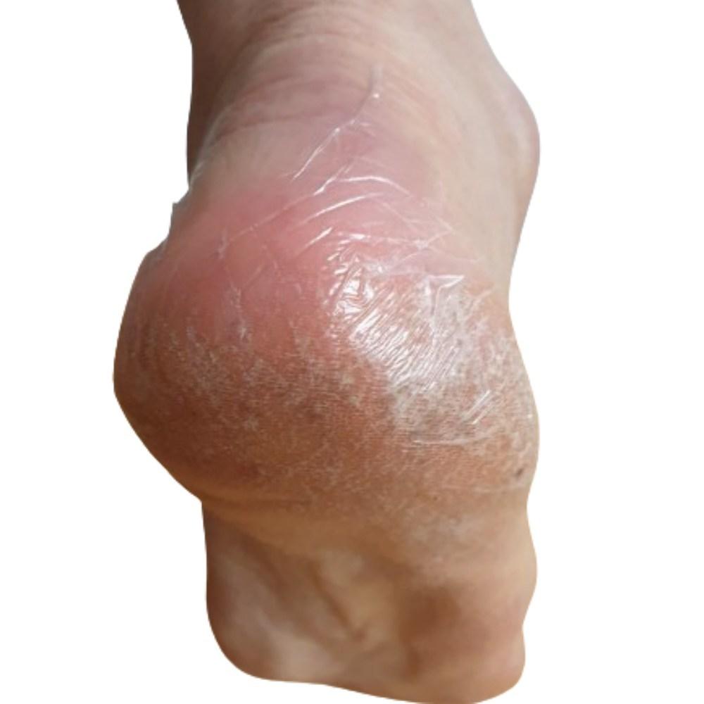 Foot Callus Removal Patch, Cracked Heels