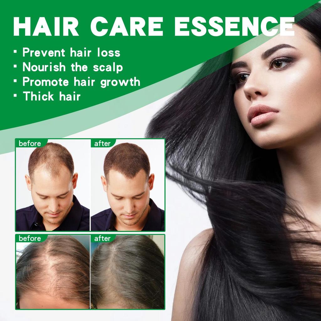 EELHOE Ginger Hair Growth Serum (30ml) - Anti-Hair Loss, Healthy Beauty, Hair Care Oil, Hair Thickening Growth Essence