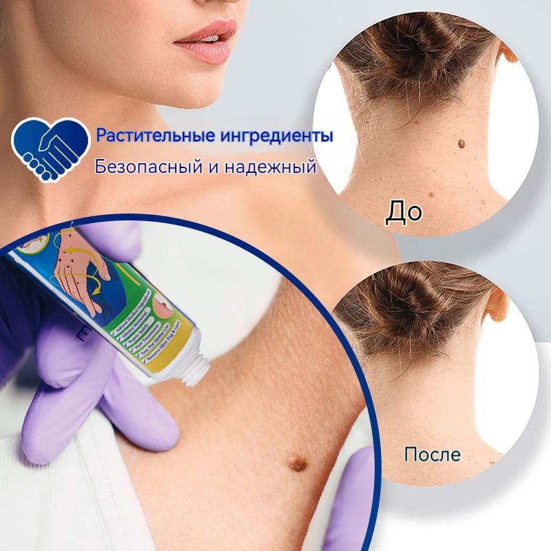 ZB Mole Removal Ointment Skin Care Mild Ingredients Collagen Daily Skin Care