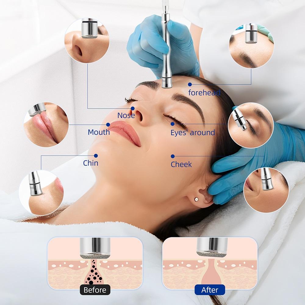Diamant Mikrodermabrasion Dermabrasion Zubehör Spitzen Für Gesichts Haut Peeling Mitesser Entferner 9 Spitzen 3 Stäbe oder 9 Spitzen 6 Spitzen