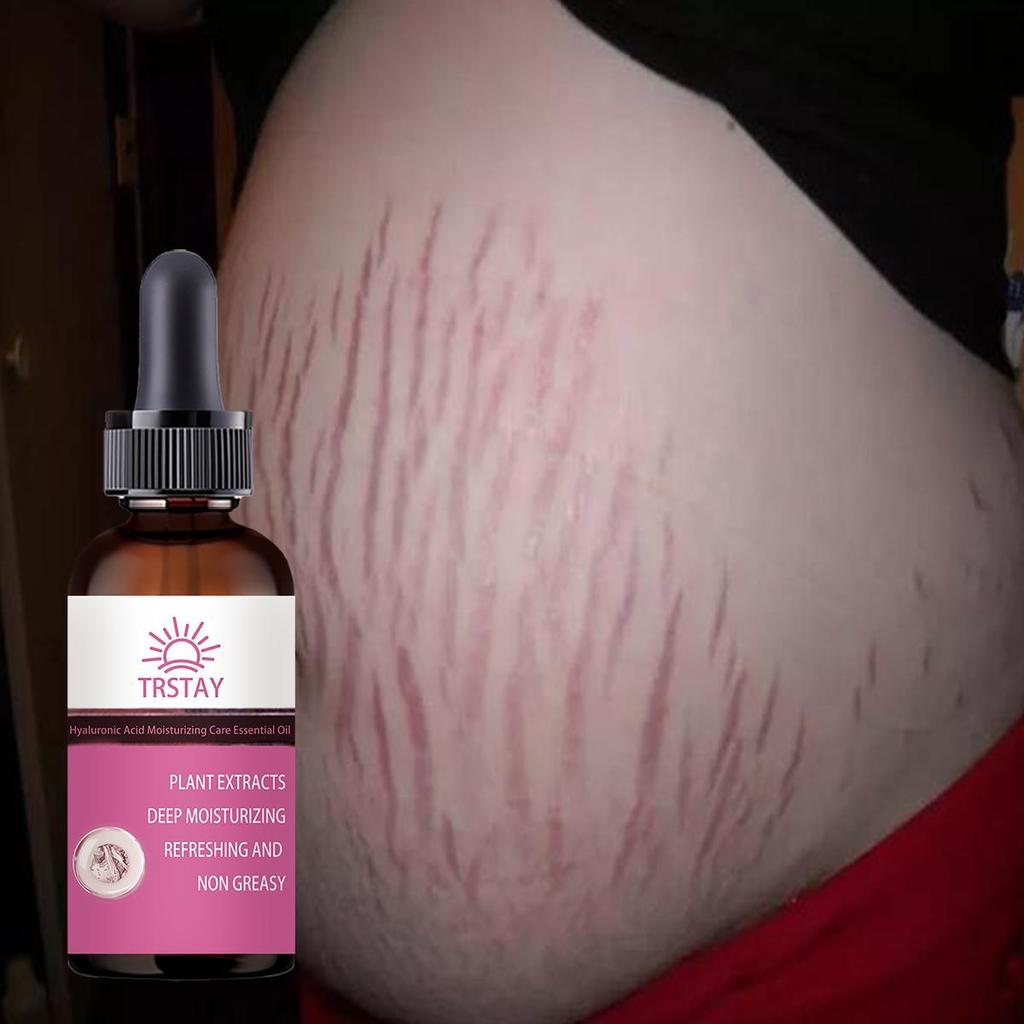 Stretch Mark Cream Scar Cream Pregnancy Cream Maternity Cream 30ml Scar Removal Repair Cream Repairs Firming Skin