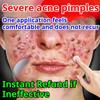 Effective Acne Removal Cream Acne Treatment Eczema Fade Acne Spots Papules Pustules Blisters Dermatitis Rash