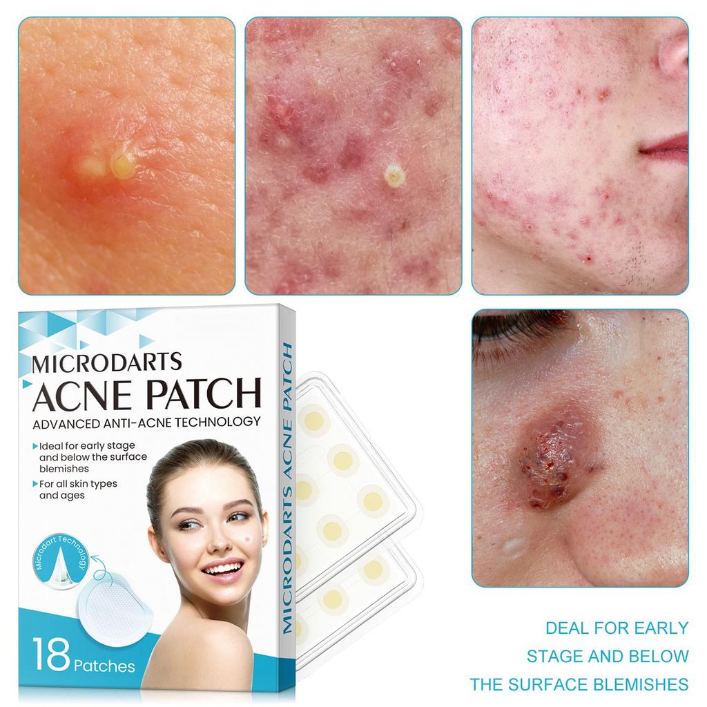 Microneedle Hydrocolloid Acne Patch To Fade Acne Marks, Acne, Acne Skin Patch.