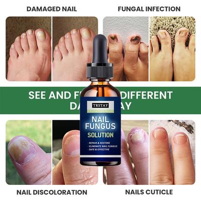 5ML/15ML/30ML/50ML/Crazylife Hand- und Fußnagel-Onycho-Reparatur-Nagel-Onychomycetant zur Verdickung des Nagelunterdrückers