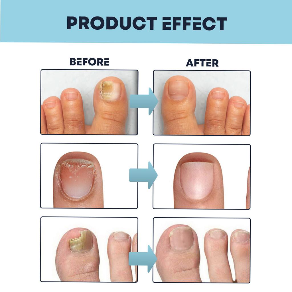 Ximonth Nail Care Spray Nourishing Moisturizing Solution For Strong Healthy Nails 30ml