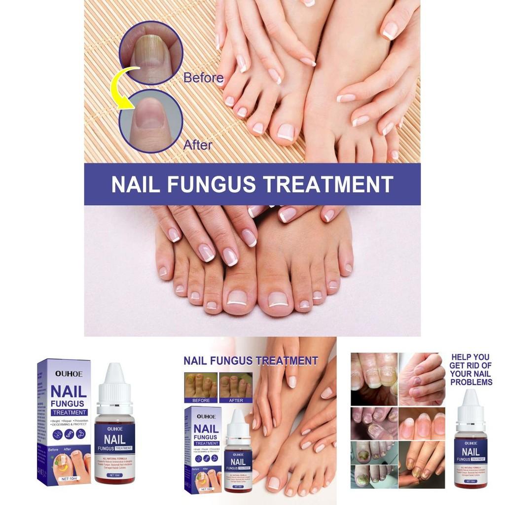 Ouhoe Nail Repair Solution Thickening Treatment For Ingrown Nails And Fungal Issues