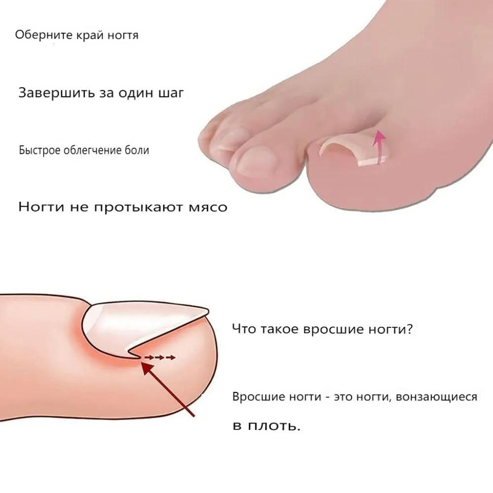 10PCS Ingrown Nail Filling Pad Sleeve Nail Pad C ,shaped Nail Pad Ingrown Nail Corrector Pedicure Tool