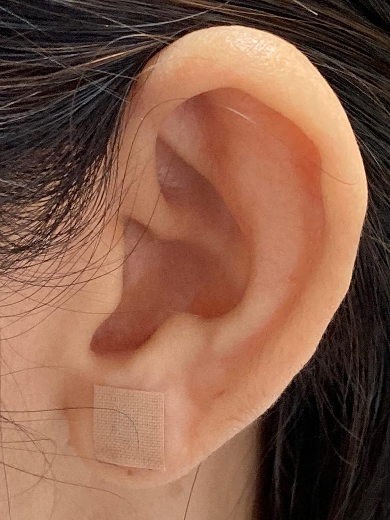 cosmetic acupuncture BI BALLY HEALTH Non-piercing