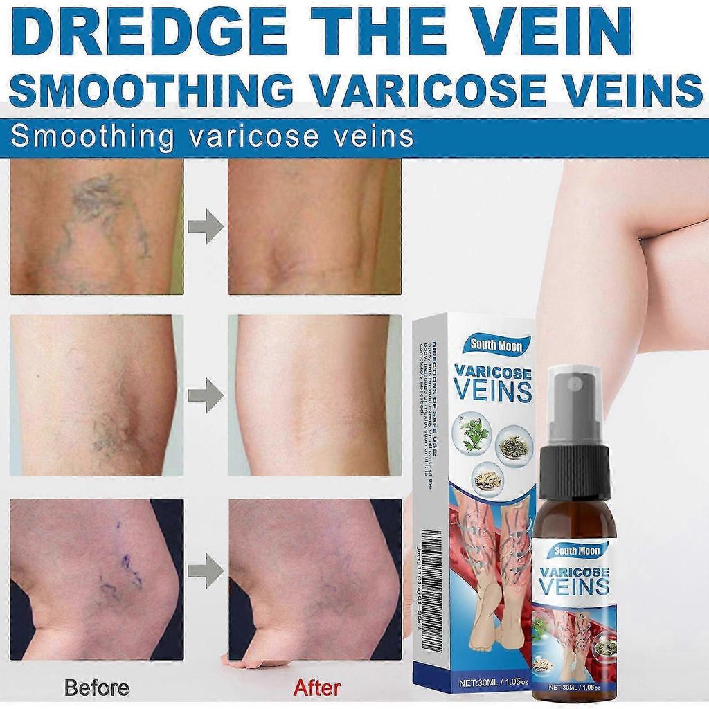 3X Varicose Vein Massage Spray for South Moon - Say Goodbye to Leg Discomfort