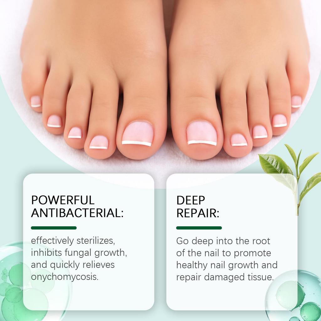 Nail Fungal Treatment Ointment Anti Infection Paronychia Onychomycosis Soft Hand Feet Toenail Repair Damaged Health Care Cream