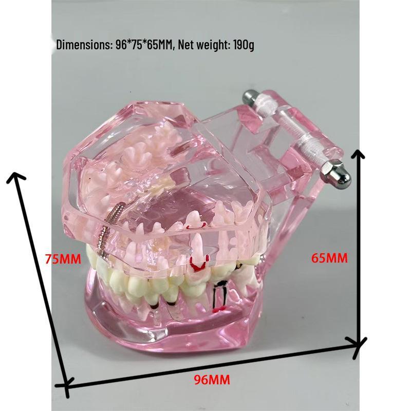 Прозора Знімна Повна Модель Щелепи з М'якими Яснами та Зубами для Підготовки до Імплантації