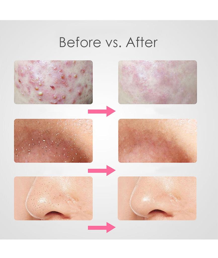 4pcs/set  Stainless Steel Blackhead Remover Tool Kit Face Massage Whitehead Pimple Spot Comedone Acne Extractor Face Massager