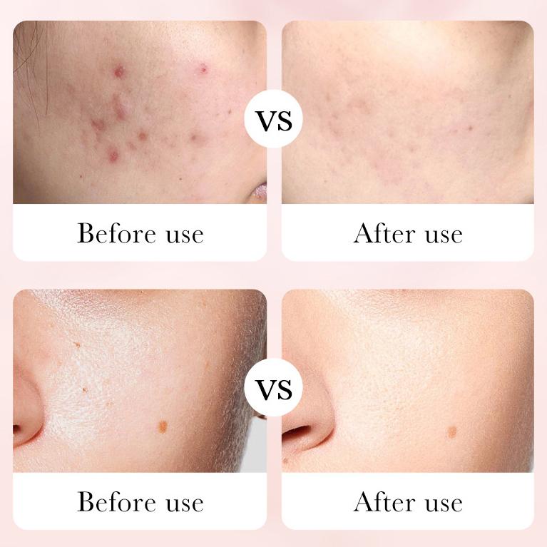 Luxury Rose Essence Anti-aging Skin Care Set Hyaluronic Acid Hydrating Anti-wrinkle and Freckle Six-piece Set