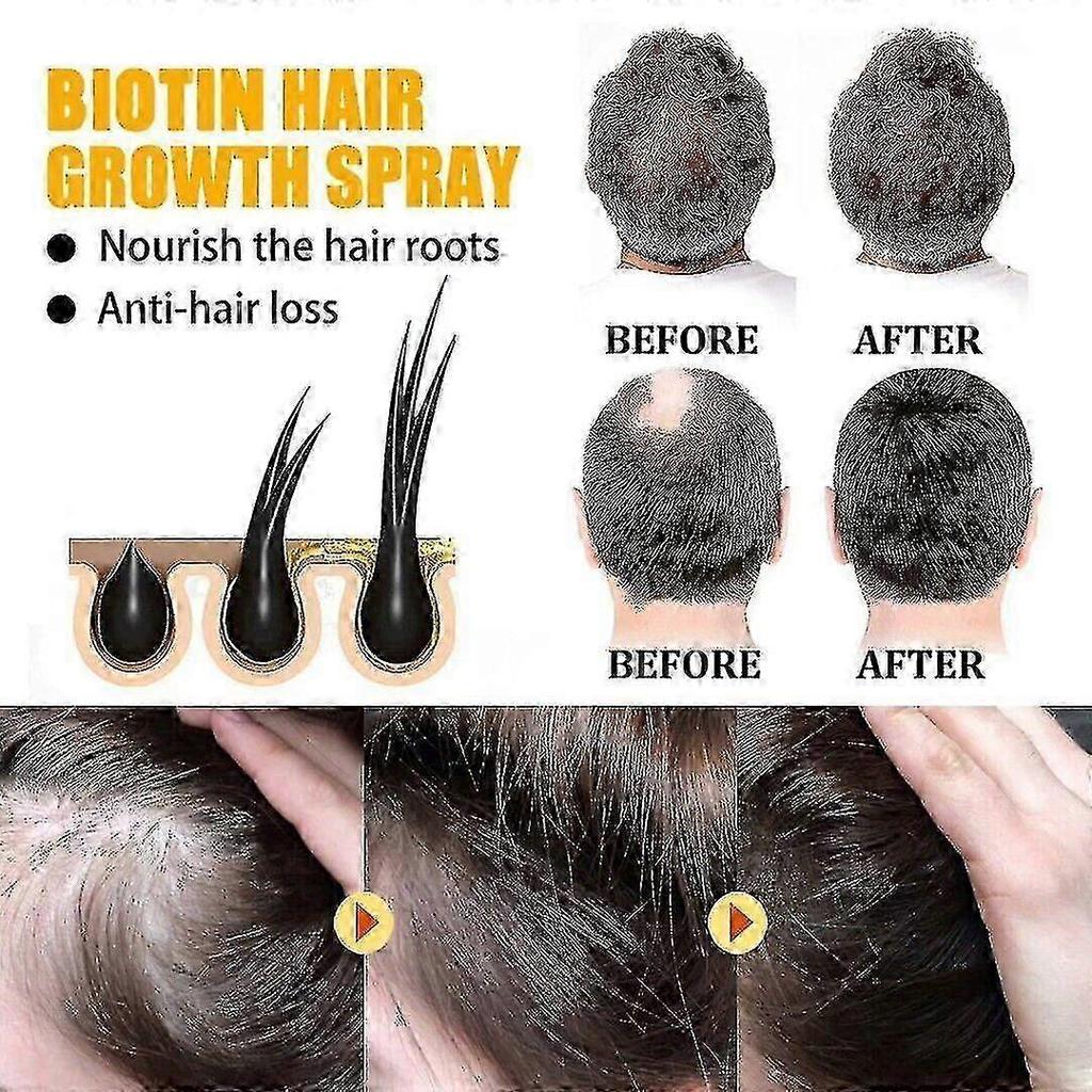 3pcs Biotin Hair Growth Spray Anti Hair Loss Fast Regrowth Scalp Treatment Serum Anti Hair Loss Spray for Men Women