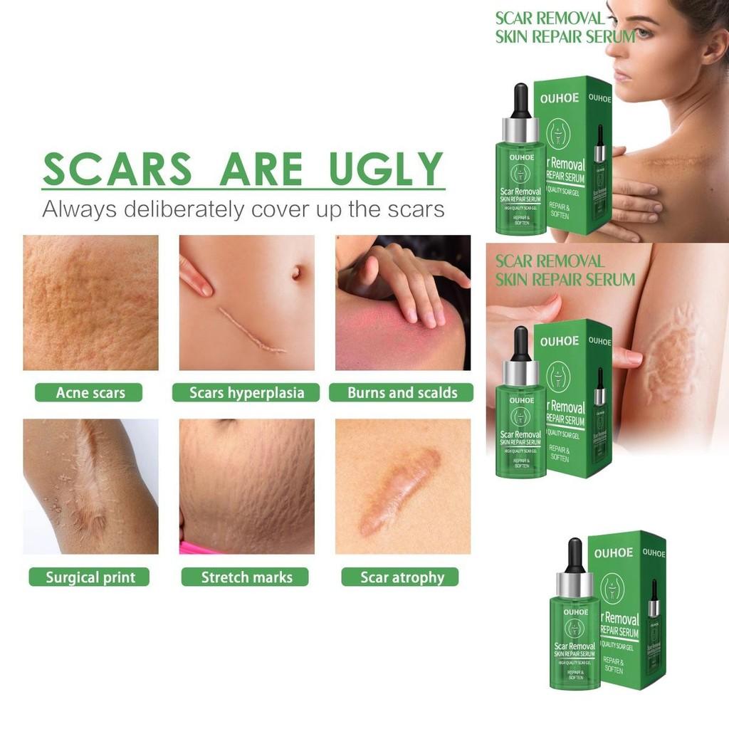 Ouhoe Scar Repair Serum For Smooth Skin Reduces Scars From Surgery And Pregnancy 30ml
