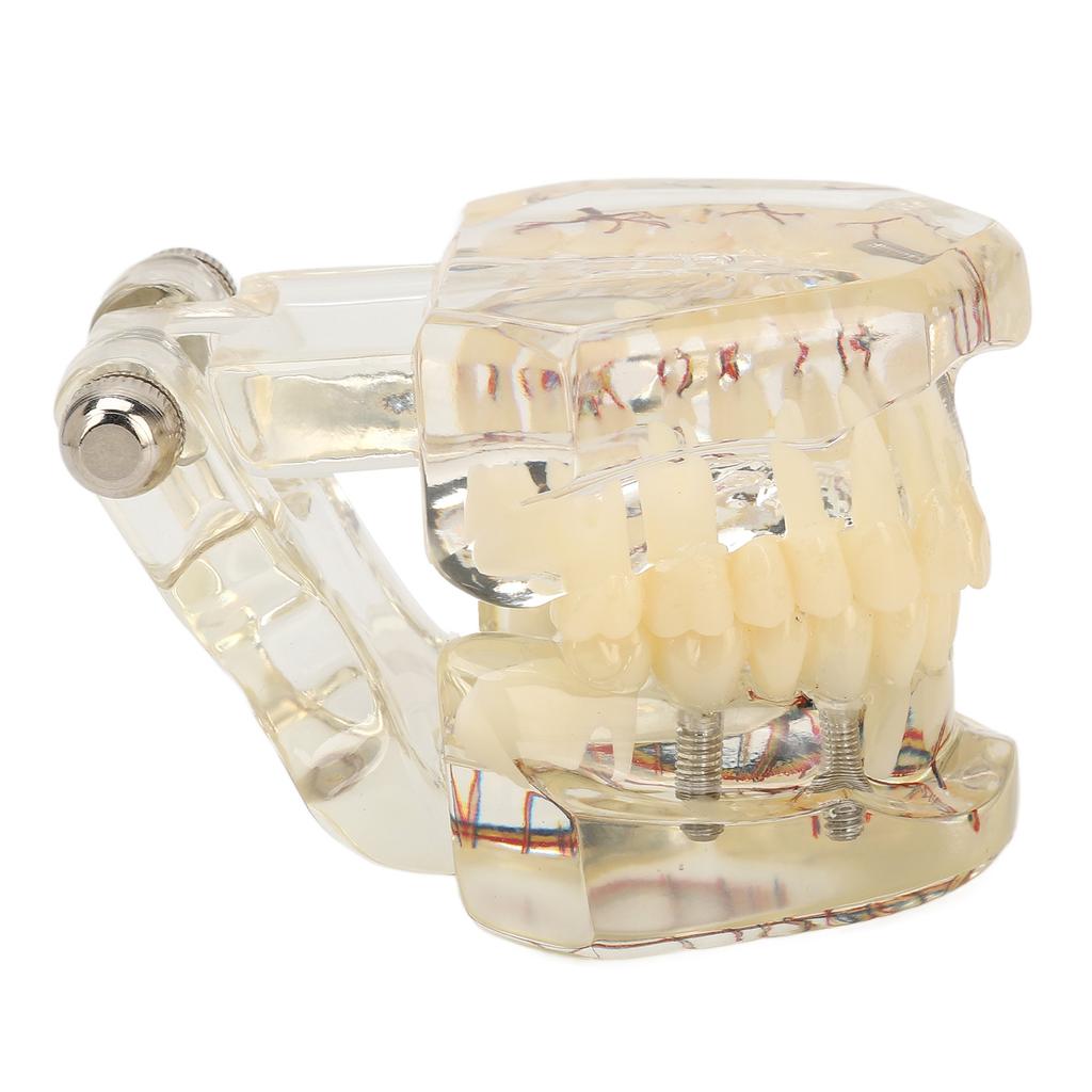 Transparent Dental Implant Pathological Model Implant Disease Teeth Model for Teaching Demonstration