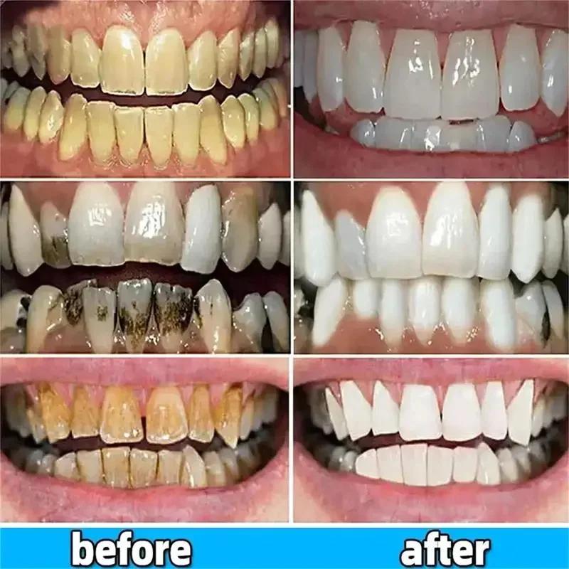 5D Whitening Teeth Stickers Gel Whitening Strips Stain Removal Oral Hygiene Care Strip Dental Bleaching Clean Oral Hygiene Teeth
