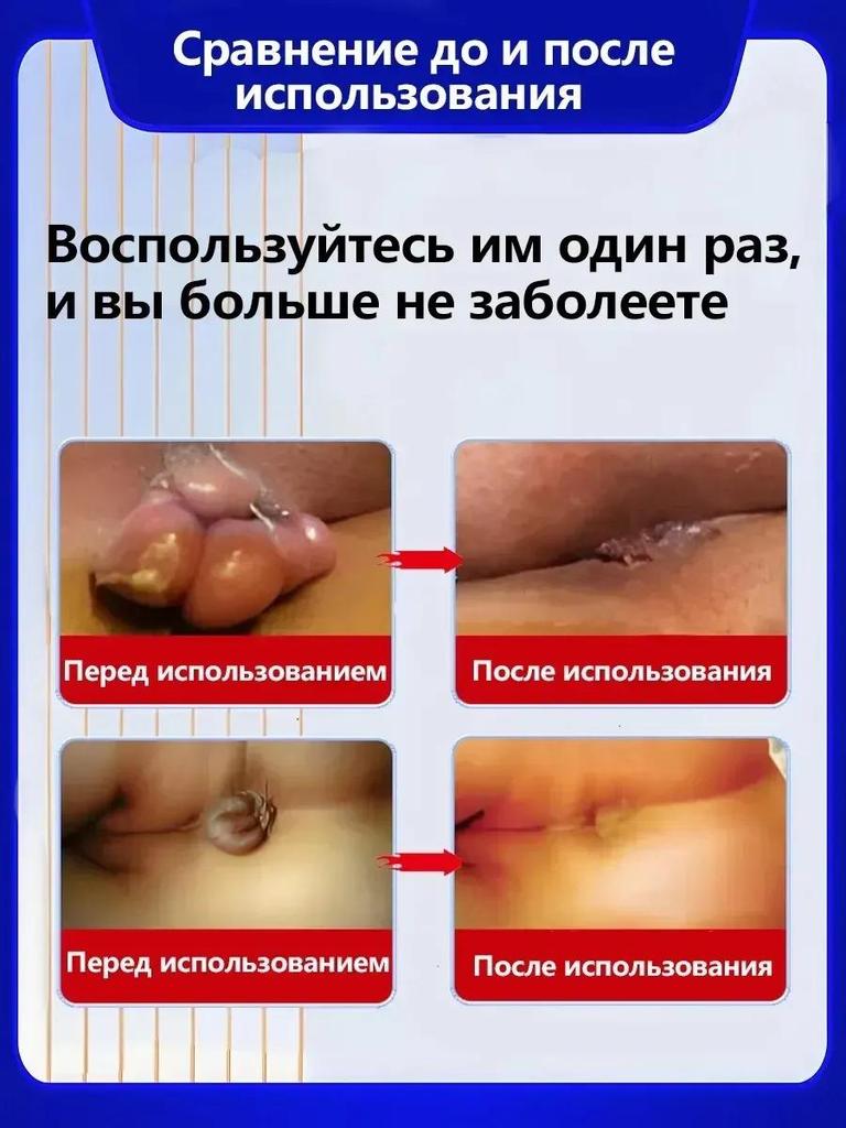 Imported medicine for anal fistula Perianal abscess Hard mass Anti-inflammatory special for anal fistula