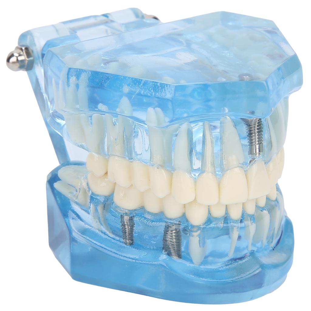 Dental Teeth Model Acrylic Blue Transparent Teaching Demonstration Simulation Teeth Model