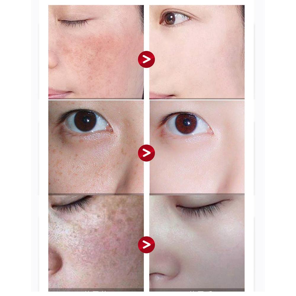 Skin Beauty Spot Removal Mask Brightening Skin Hydrating Moisturizing Mask Pore Shrinking Facial Treatment