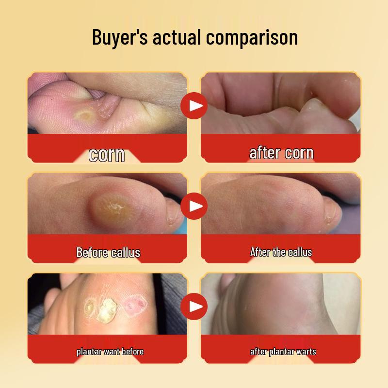 Corn Plaster & Ointment for Foot Calluses: Qingjianling Cream & Jiyoukang Patch