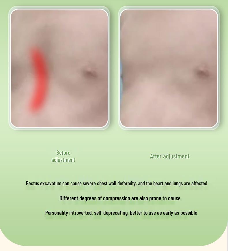 Korektor s přísavkou Pectus Excavatum pro prohlubeň hrudníku