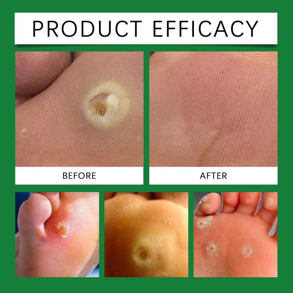 Zehen Hühneraugen Entfernung Pflaster Salicylsäure löst Hornhaut Hühnerauge Nagelhaut Fuß Glatte Pflege Patch