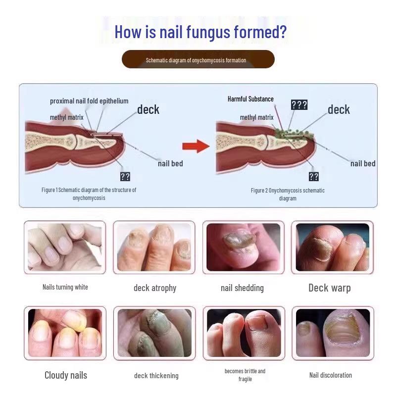 Newcomer Discount: Electric Nail Grinder for Onychomycosis - Toenail Manicure Tool