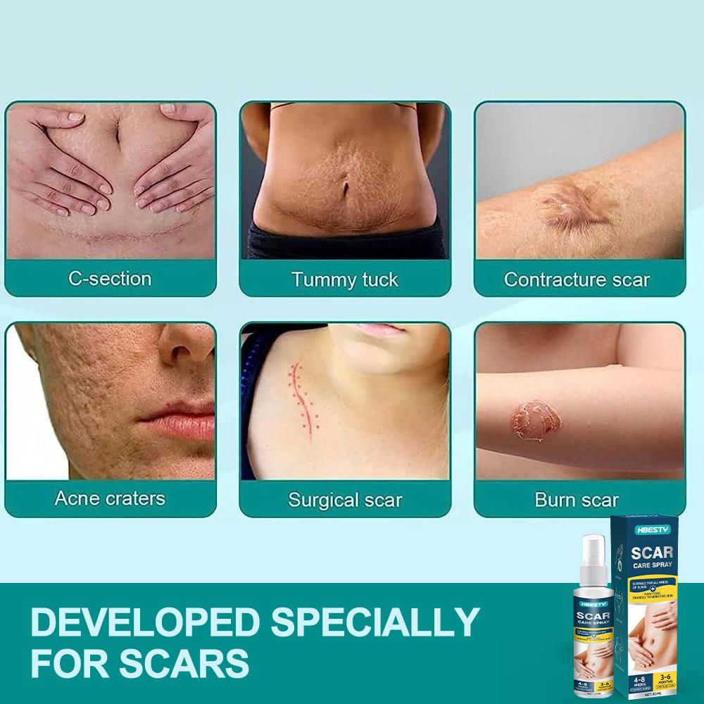 Hbesty Scar Spray Advanced Care For Postsurgical And Burn Recovery Suitable For All Types Skin
