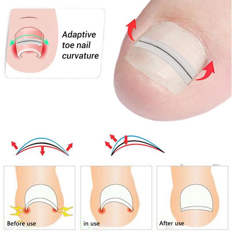 Ingrown Toenail Correction Tool Straightening Clip Brace Ingrown Toe Nail Treatment Elastic Patch Sticker Pedicure Tool