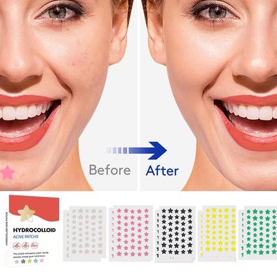 Parche para el acné de gran volumen y color mezclado con forma de estrella, suave, no irritante, atenúa el acné, mejora el acné, boca cerrada, hidrocoloide muscular