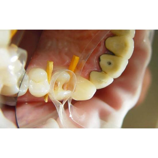 ET Dental Wooden Wedges Kit