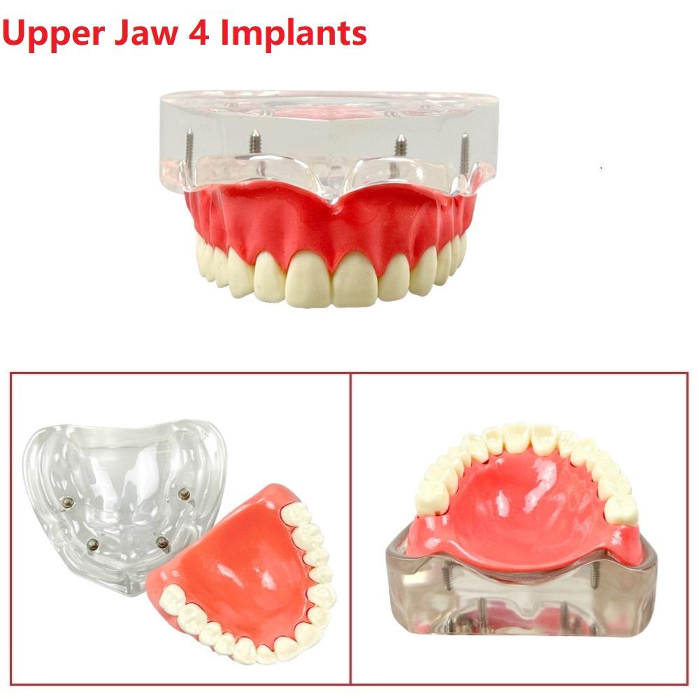 4/6 Implants Dental Model Overdenture Restoration Model Removable Teeth Model Upper/Lower Jaw With Implant Screwdriver for Teach