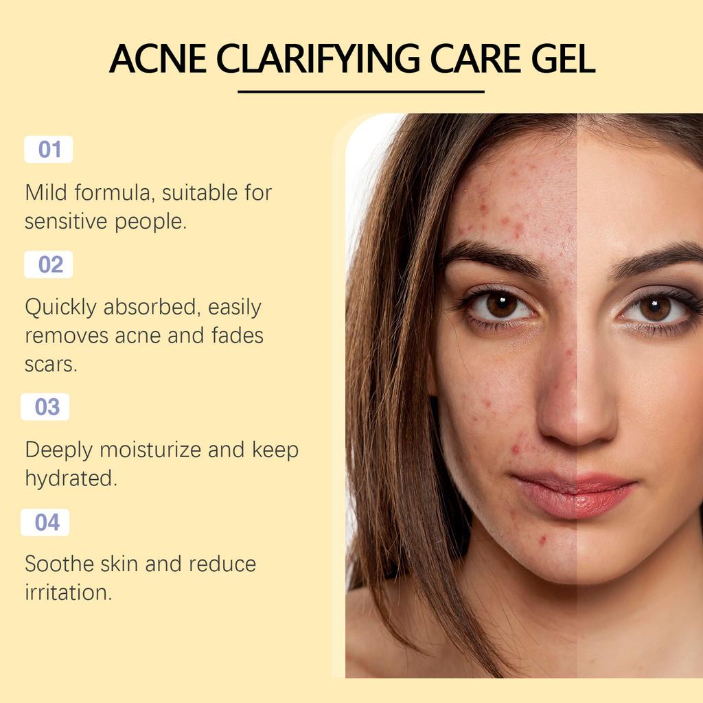 Ouhoe Acne Gel For Deep Cleansing And Brightening Skin With Pore Minimizing Formula 20g