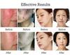 SPA Use Cold Plasma Pen Ozone Acne Remover Wrinkle Removal Skin Rejuvenation Sterilization Anti-inflammation Beauty Instrument