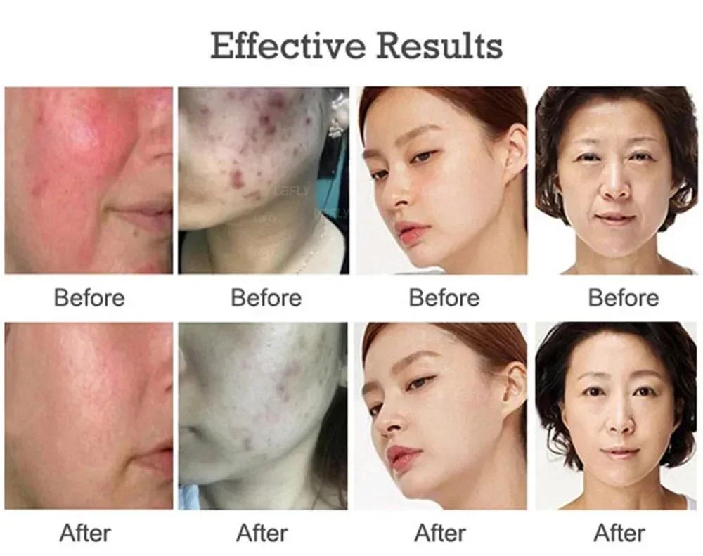 SPA Use Cold Plasma Pen Ozone Acne Remover Wrinkle Removal Skin Rejuvenation Sterilization Anti-inflammation Beauty Instrument