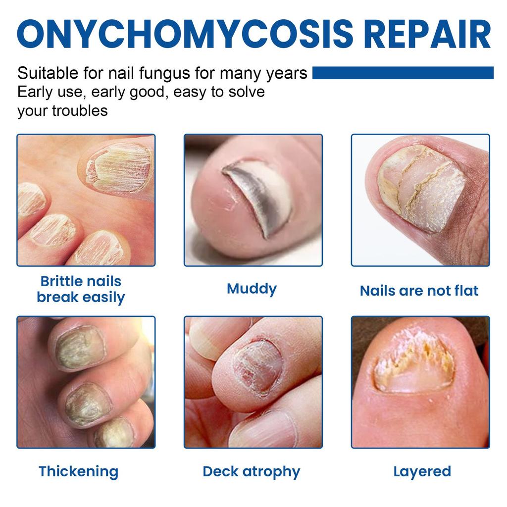 Tånagelsvampsplåster, Nattnagelvårdsplåster, Snabba nagelvårdsplåster, Minska Onychomycosis Och Mjuka Naglar (32 st/kartong) 2 st