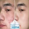 Cream To Lighten Acne Marks Skin Care Firming Skin Tightening Cream
