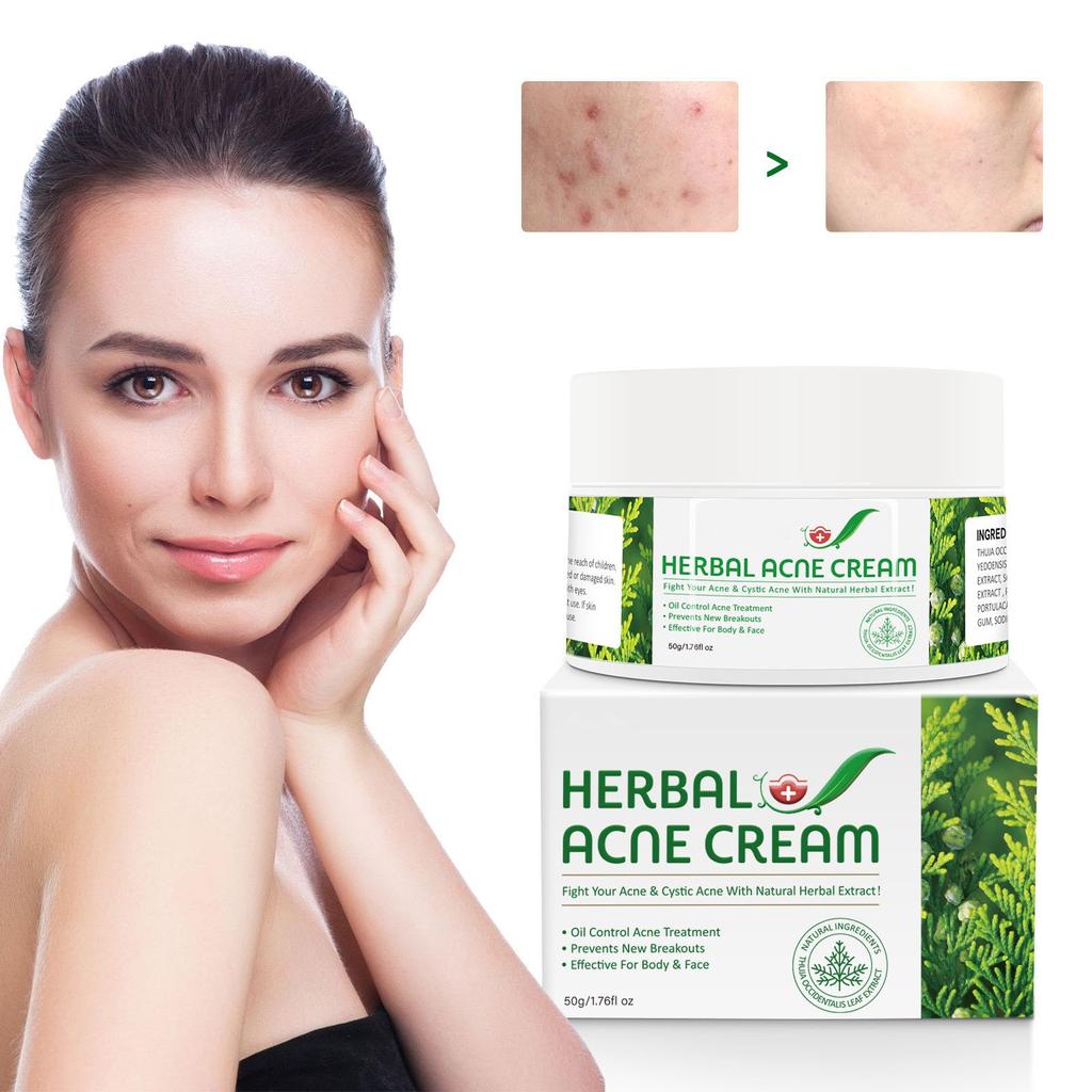 Herbal Acne Creams Anti-Pimple Creams Anti-Acne Creams Acne Balance Water And Oil Skin Blemishes Effective For Body And Face 50g