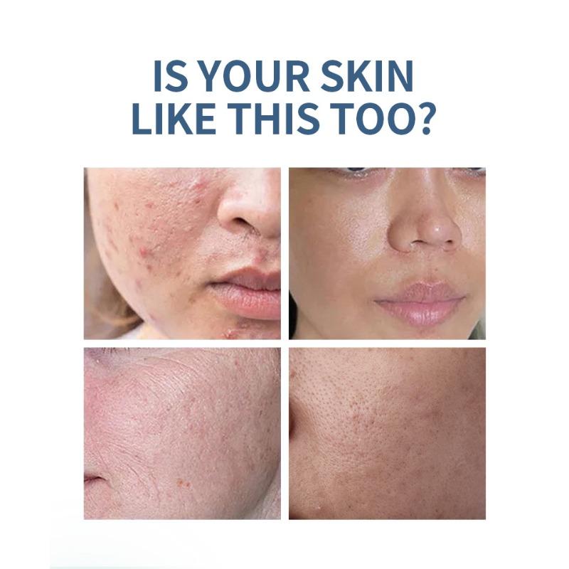 Essence Salicylic Acid Acne Removal HBA Fruit Acid Desalinates Acne Pit Pit Pit Closed