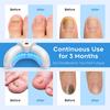 Wireless Nail Fungus Laser Device 45W 14pcs 470nm Blue Light 3-10 Minutes Toenails Anti Infection Paronychia Onychomycosis Care