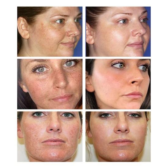 30ml Entfernen Dunkle Flecken Sommersprossen Creme Vitamin C 20 Tragbare C20 Aufhellung Sommersprossen Spot Creme für Frauen