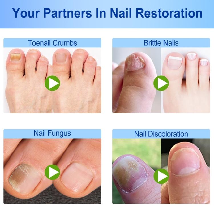 Ingrown Toenail Sticker Corrector Patches Big Toe Nail Corrector Renewal Plaster