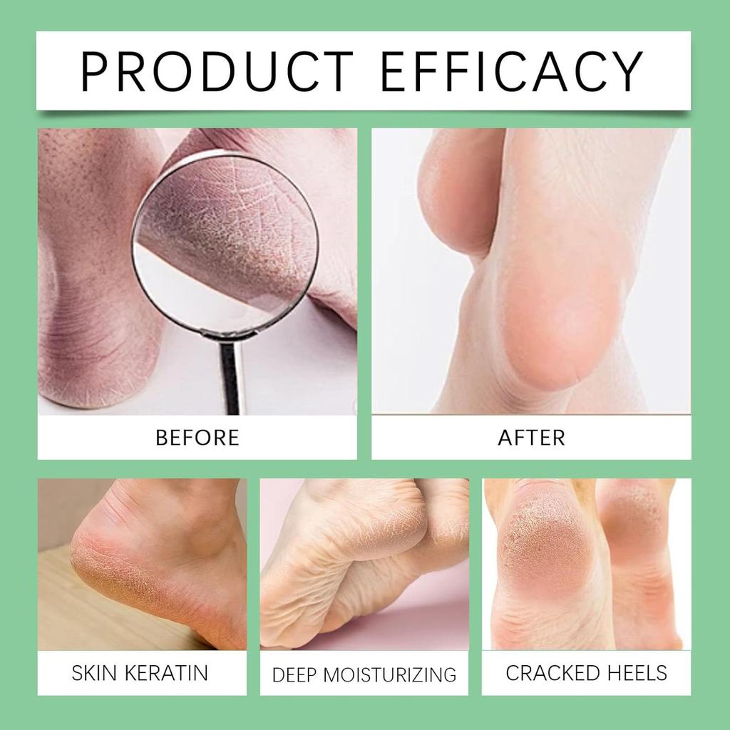 Lifesparking 7 Day Feet Callus Remover, 7 Day Ginger Foot Spray, Foot Ginger Nourishing Spray, Instant Feet Exfoliating Serum, Moisturizing & Smooth