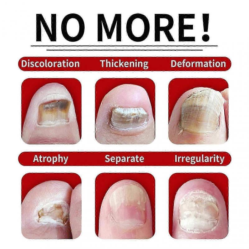 Jaysuing 7 Days Nail Fungus Treatment, Fast-Acting Nail Repair Serum with Ginger Formula, Promotes Healthy Nail Growth