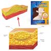 ZB Lipoma Patch Natural Herbal Lipoma Lump Removal Patches, Lipoma Removal Stickers 6pcs/bag