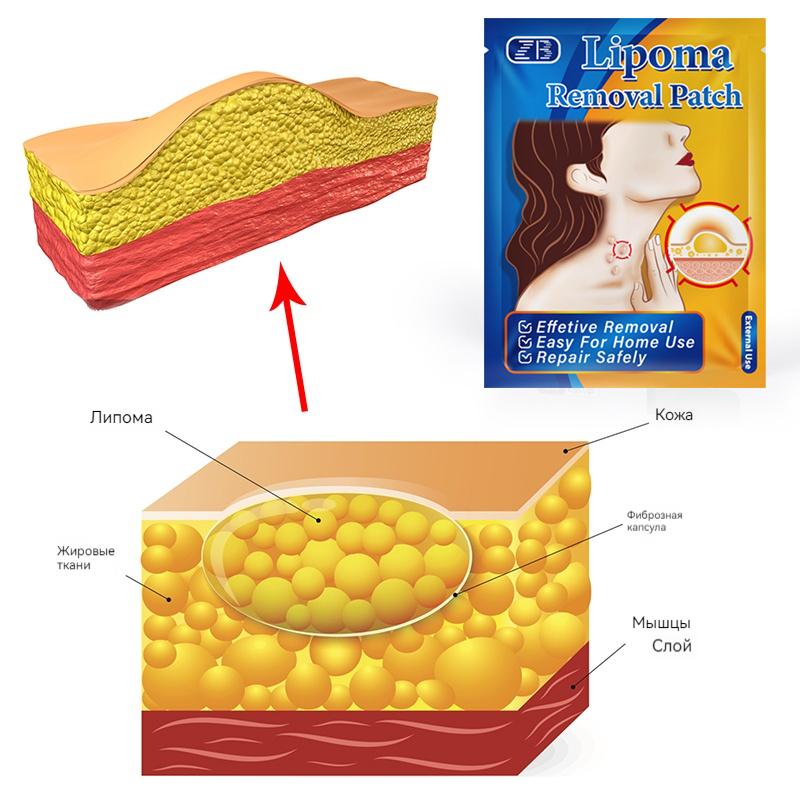 ZB Lipoma Patch Natural Herbal Lipoma Lump Removal Patches, Lipoma Removal Stickers 6pcs/bag