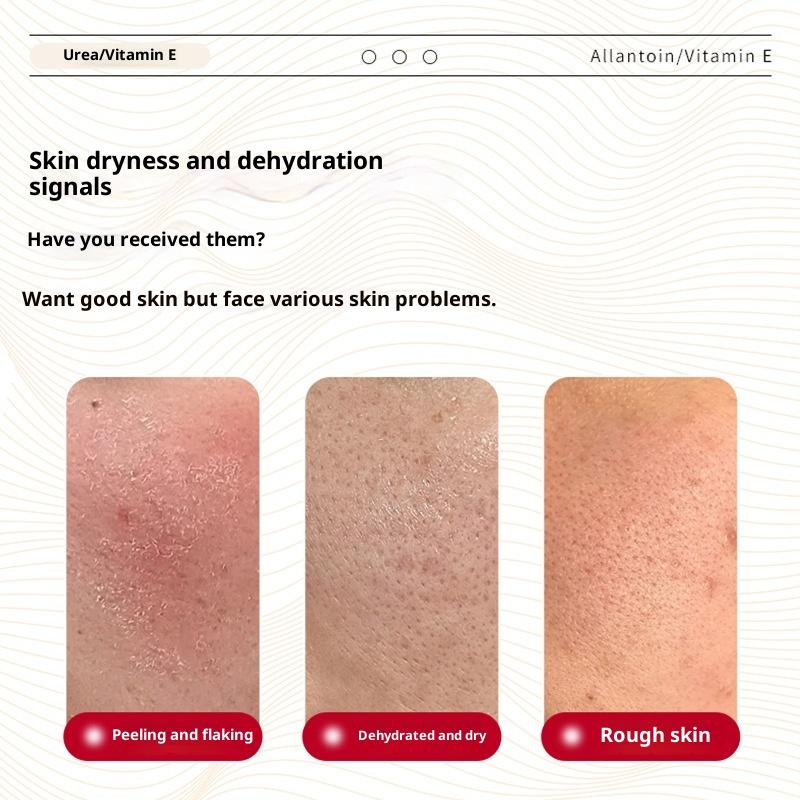 Urea Vitamin E Cream Moisturizing Cream To Improve Blackhead Acne