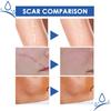 5-Day Recovery Scar Cream Fast Removal Skin Scars Treat Surgery Scars Stretch Marks Acne Pox Prints Burn Repair Facial Care Gel