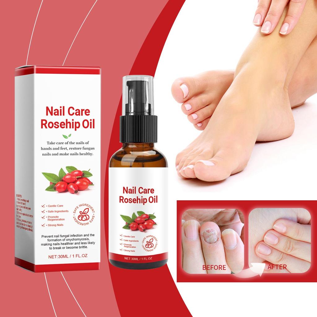 Rosehip Oil Nail Care Liquid Nourishing Moisturizing To Remove Onychomycosis Hand And Foot Nail Care Products Fungus Care 30ML